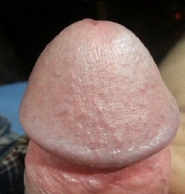 Fotografie zvětšeného žaludu penisu