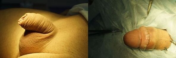 penis před a po operaci zvětšení