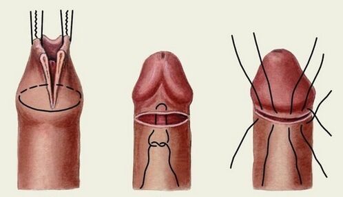 podstata operace rozšíření penisu