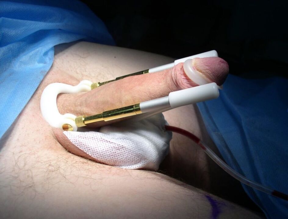 prodlužovač po operaci zvětšení penisu