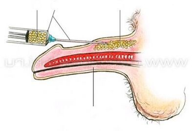 injekční zvětšení penisu